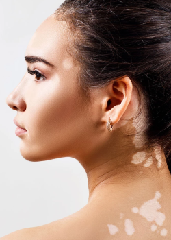 Autoimmunerkrankungen der Haut