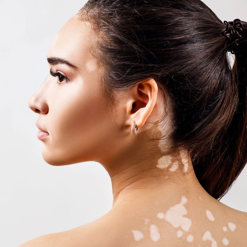 Autoimmunerkrankungen der Haut –Auslöser und Therapien