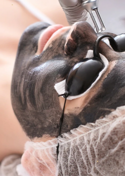 Carbon Peeling Hamburg