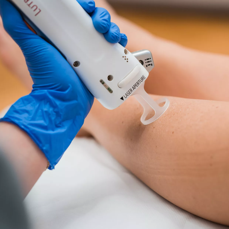 Epilationslaser-Therapie