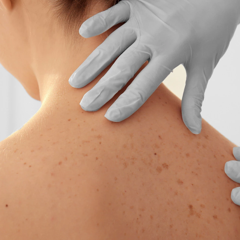 Hautkrebs-Screening & Hautkrebsvorsorge in Hamburg