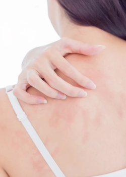 Neurodermitis, Ekzemen und Juckreiz