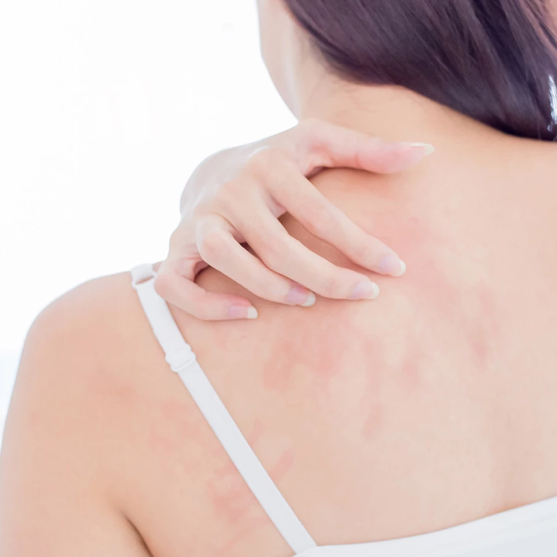 Neurodermitis, Ekzemen und Juckreiz