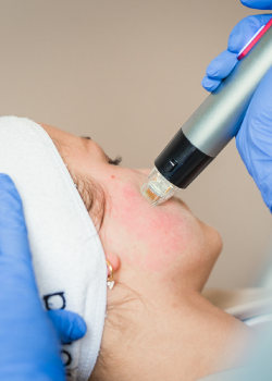 Microneedling mit Radiofrequenz: Innovations-Behandlung für die Hautverjüngung und -regeneration
