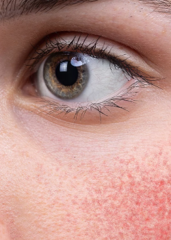 Rosacea-Behandlung